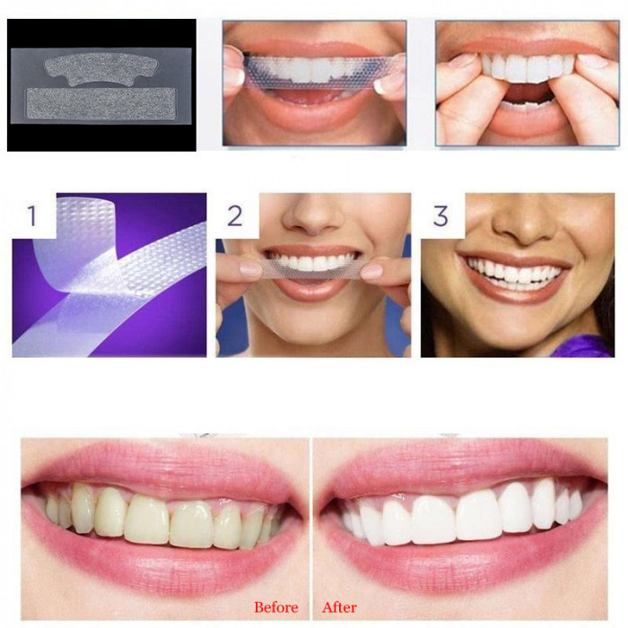 Teeth Whitening Strips - Teeth Whitening Gel