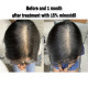 Traitement de la repousse des cheveux Alopécie Perte de cheveux Croissance des cheveux 30ml 50ml