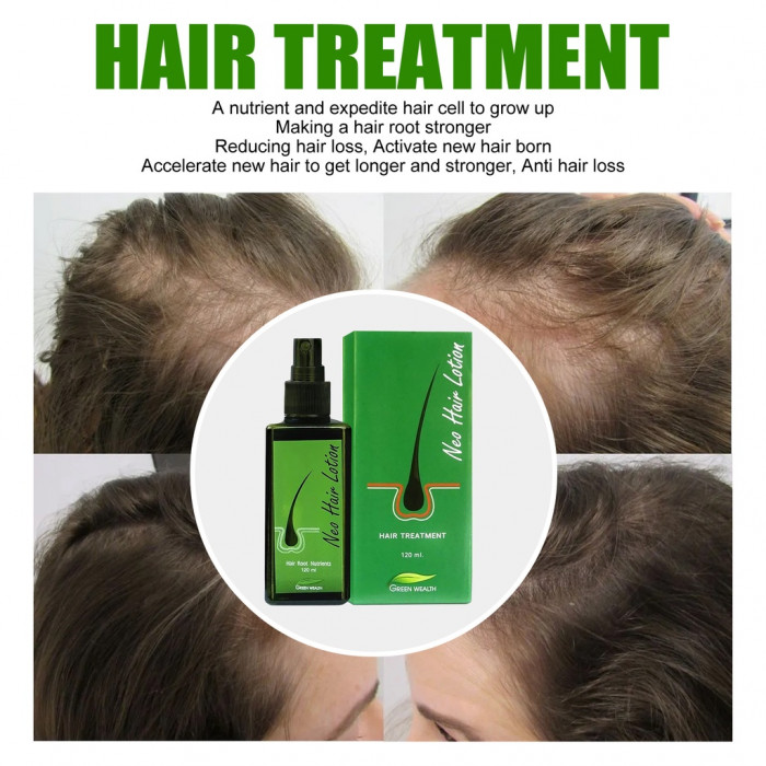 Neo Hair Lotion 120ml Neo Hair Lotion Green Wealth Spray Root Nutrients Hair  Loss Treatments (120Ml x 4 Bottle) Set0614245945 [Get Free Tomato Facial  Mask] in Kuwait | Whizz Hair Regrowth Treatments